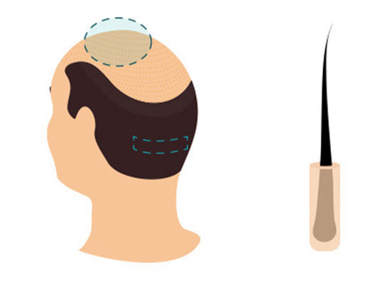 DHI Hair Transplant Technique